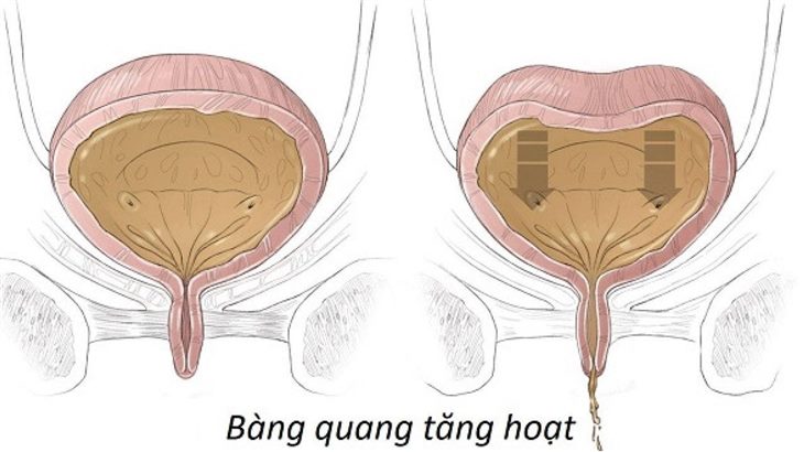    Bàng quang kích thích (bàng quang tăng hoạt) dẫn đến tiểu không tự chủ ở người già