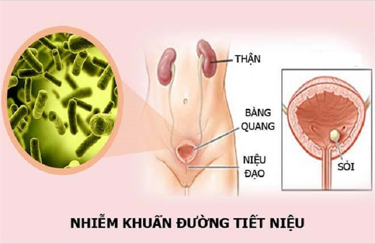 Tiểu nhiều lần trong ngày do nhiễm trùng tiết niệu